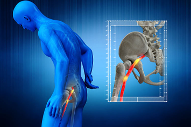 sciatica