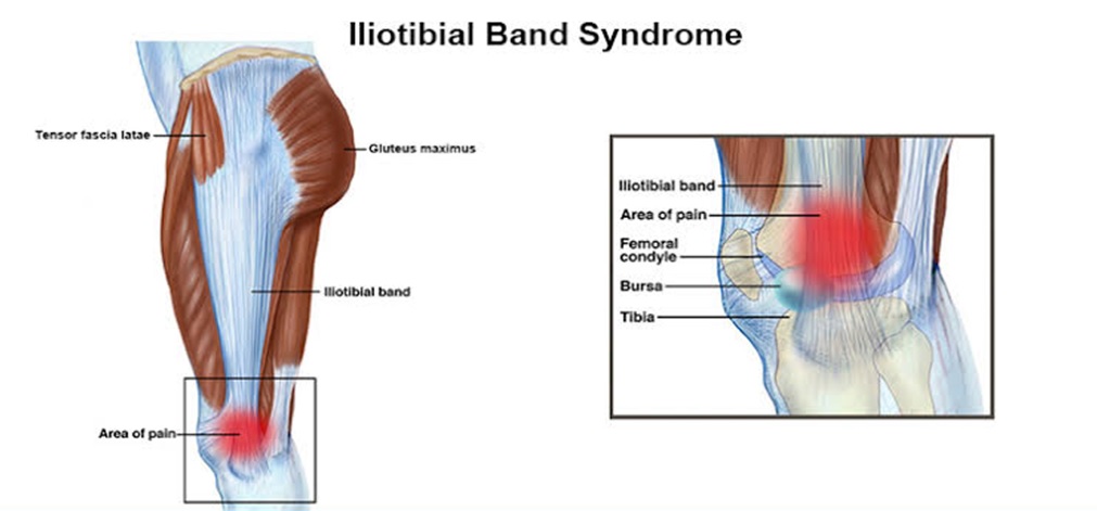 Iliotibial Band Syndrome